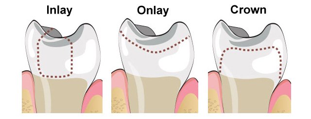 Costa Rica Dental Inlays vs Onlays vs Crowns