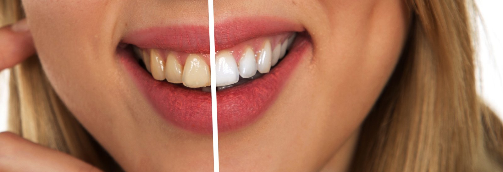 teeth whitening kit