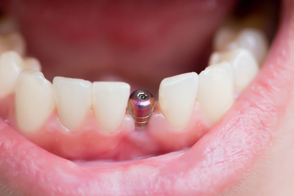 Bridge Vs Implant What's the Difference Between These Two Dental