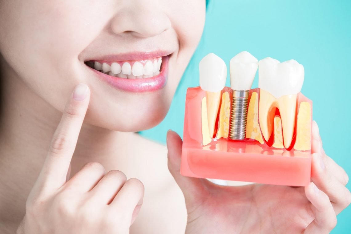 Top 10 Dental Implant Care Tips - Advance Dental Clinic Costa Rica