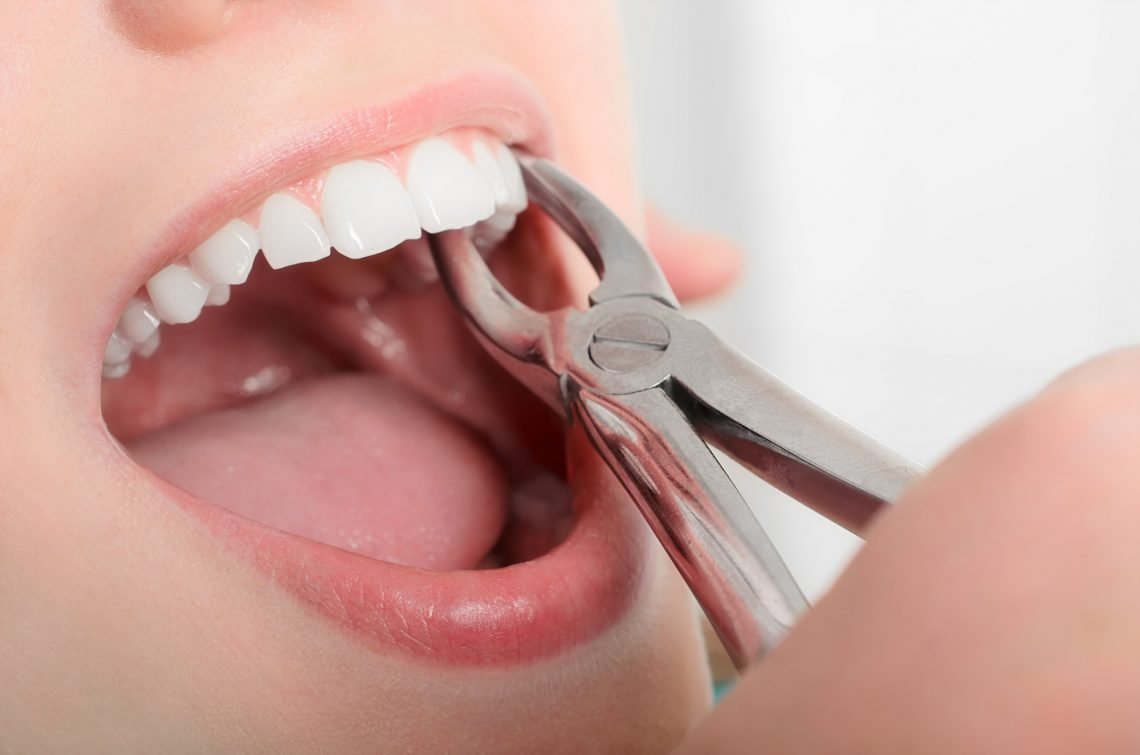 7 Times When a Tooth Extraction Might be Necessary