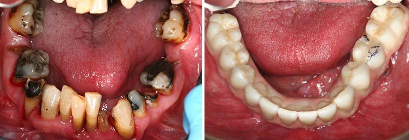 Costa Rica Full Mouth Restoration Image 7