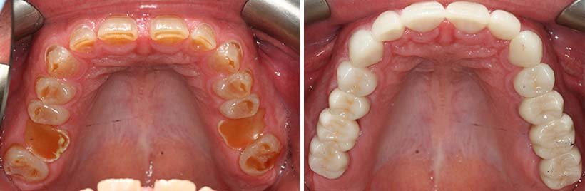 Costa Rica Full Mouth Restoration Image 2
