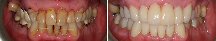 Costa Rica Full Mouth Restoration Image 10