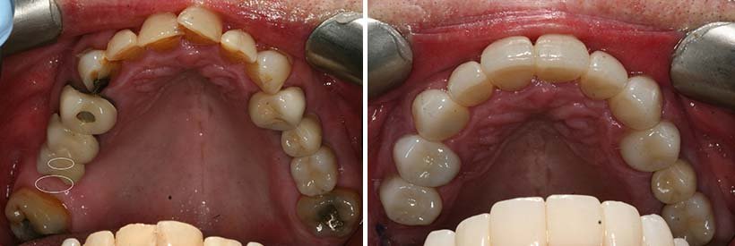 Costa Rica Full Mouth Restoration Image 11