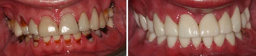 Dental Crowns Costa Rica - Before and After
