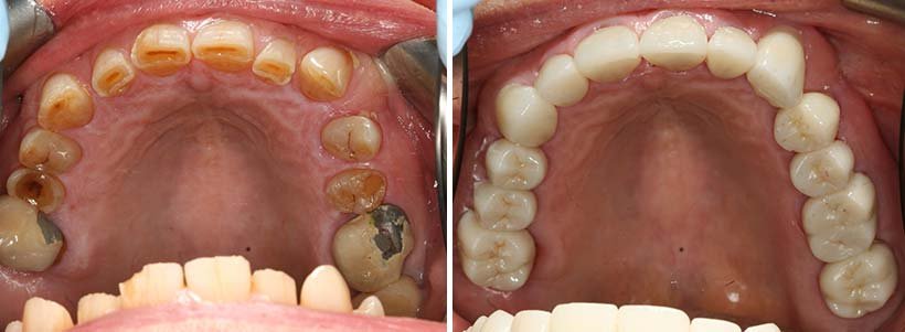 Dental Crowns Costa Rica - Before and After 2