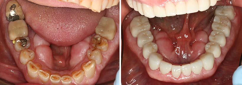 Dental Crowns Costa Rica - Before and After 3