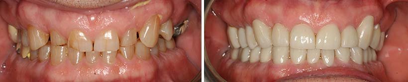 Dental Crowns Costa Rica - Before and After 4