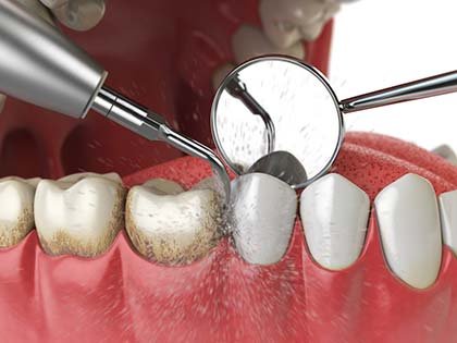 Teeth Cleaning and Dental Evaluations